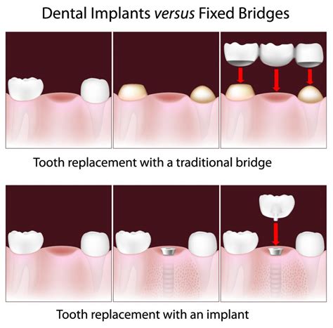 Single Tooth Dental Implants Hillsborough Nj