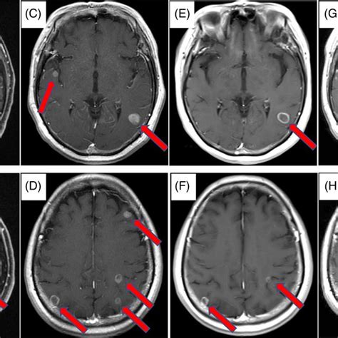 A B A Single Brain Metastasis Was Detected Before Chemotherapy C