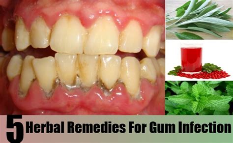 Top 5 Herbal Remedies For Gum Infection Natural Home Remedies