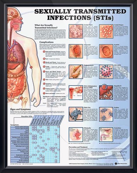 Sexually Transmitted Infections Chart 20x26 Nurse Practioner Nursing