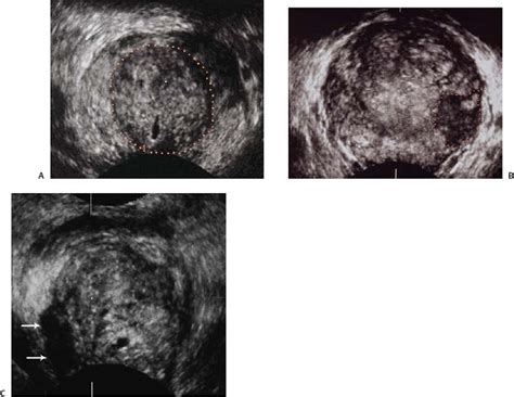 Elevated PSA And Or Abnormal Prostate Physical Examinations Diagnosing Prostate Cancer