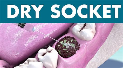 Dry Socket Treatment Services In Jamaica Ny