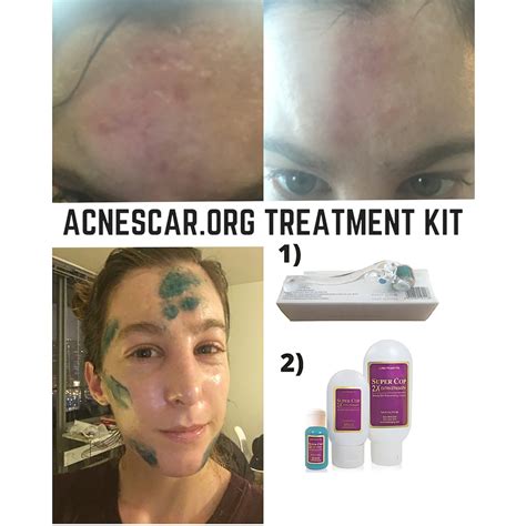 Acne Scars Indented Atrophic Rolling Pitted Deep Heal Remove Treat Get