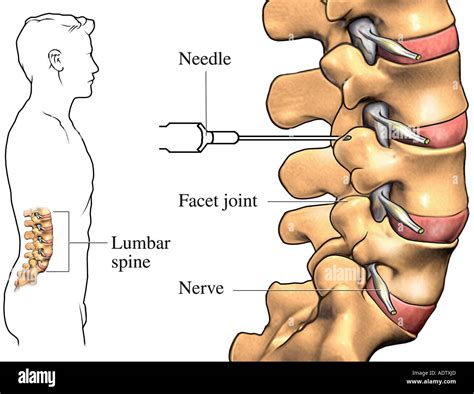 Lumbar Facet Joint Hi Res Stock Photography And Images Alamy