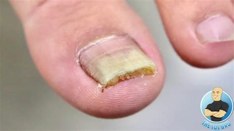 Is This Toenail Fungus Learn All About Nail Fungus Treatment