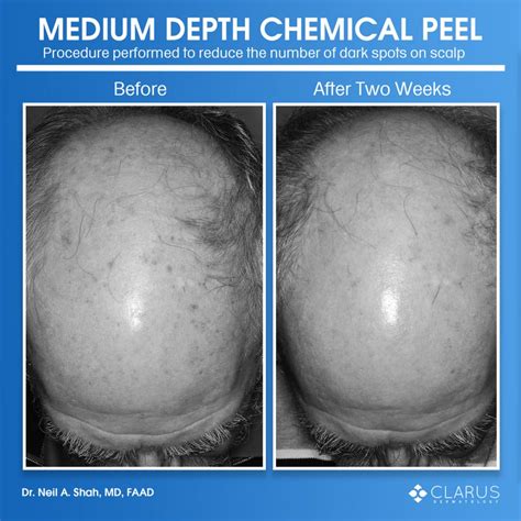Medium Depth Chemical Peel On The Scalp Clarus Dermatology