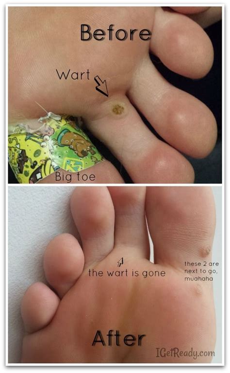 How To Get Rid Of Warts Without Duct Tape Get Rid Of Warts Warts