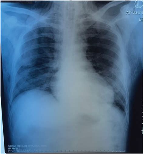 Surgical Emphysema X Ray Sexiz Pix Vrogue Co