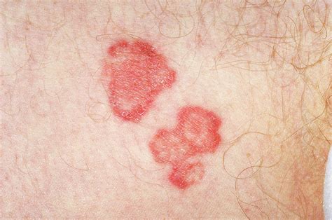 Ringworm Photograph By Dr P Marazziscience Photo Library