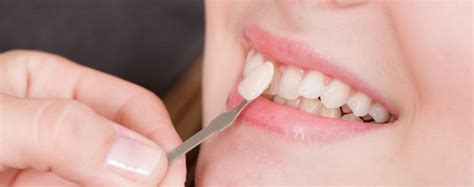 Dental Veneers Select Smiles Dentists Ringwood Dental Implants Melbourne Dental Implant