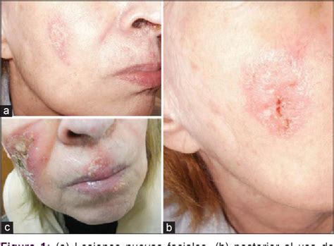 Figure 1 From Lupus Eritematoso Crónico Discoide Hipertrófico Simulando