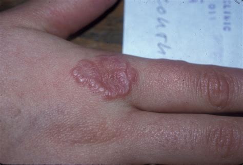 Granuloma Annulare Pictures Causes Diagnosis Complications And