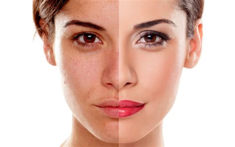 Skin Discoloration Causes And Remedies Lerboristica Di Athenas
