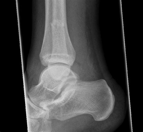 Chaput Tubercle Syndesmosis Avulsion Weber C Bilmalleolar Ankle Fracture