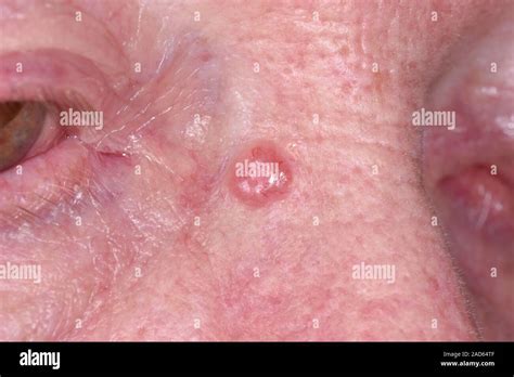 Basal Cell Carcinoma Skin Cancer Close Up Of A Nodular Basal Cell
