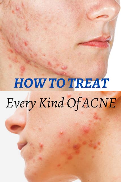 How To Treat Every Kind Of Acne