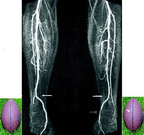 Claudication Of The Foot In A Rugby Player Circulation