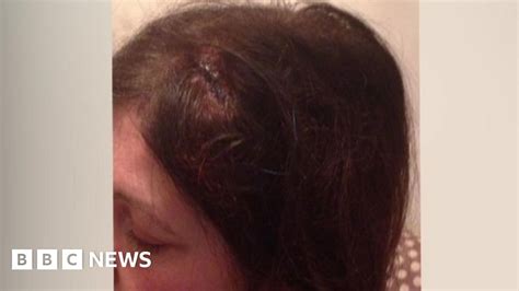 Womans Skull Fractured By Brick Thrown At Birmingham Bus Bbc News