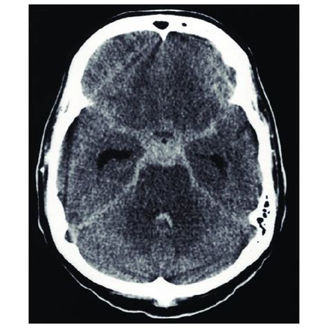 Angiograms Demonstrating Cerebral Vessel Narrowing After Subarachnoid