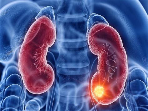 Kidney Cancer Symptoms Causes And Treatment