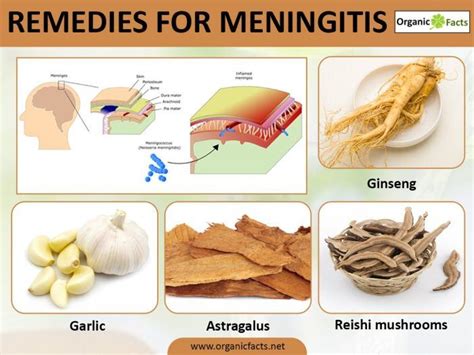 Remedies For Meningitis Infographic Meningitis Remedies Home Remedies