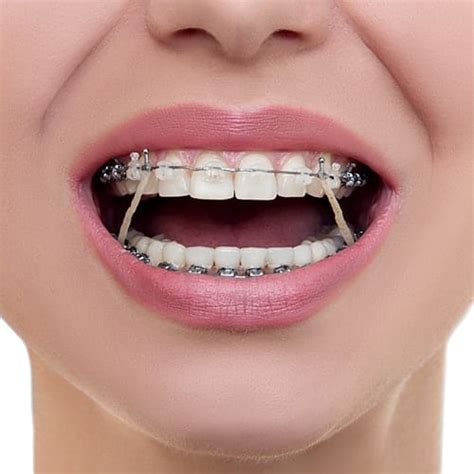 Top 3 Reasons To Get Braces In Scarborough