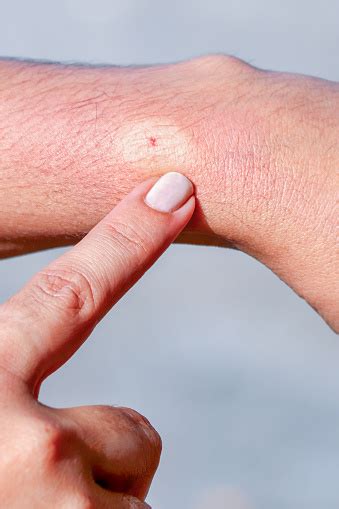 Bee Sting On Human Skin Stock Photo Download Image Now Istock