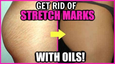 Top Oils That Get Rid Of Stretch Marks How To Remove Fade Stretch