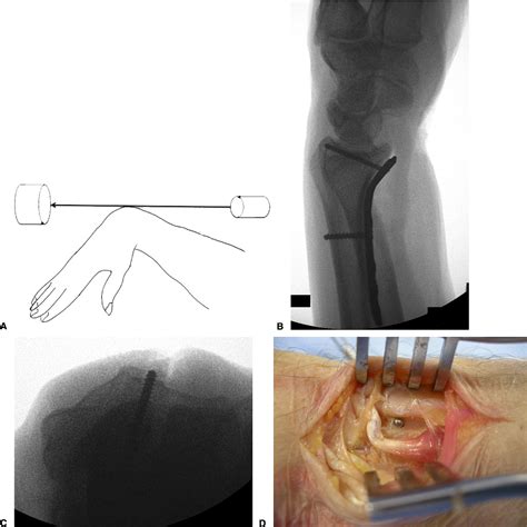 Comparison Of Fluoroscopic Views For Dorsal Cortex Screw Penetration After Volar Plating Of