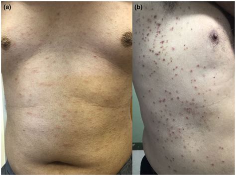 A Maculopapular Lesions And B Papulovesicular Lesions Download