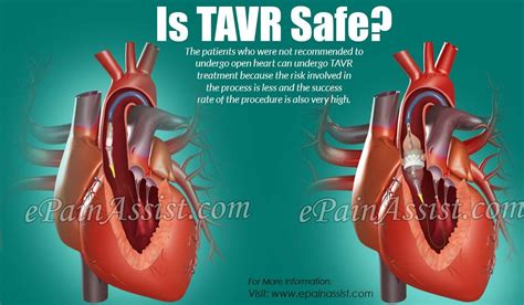 Is Tavr Transcatheter Aortic Valve Replacement Safe Icu Nursing