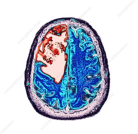 Glioblastoma Brain Cancer Ct Scan Stock Image C0509707 Science
