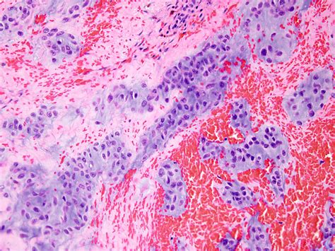 Pathology Outlines Extraskeletal Myxoid Chondrosarcoma