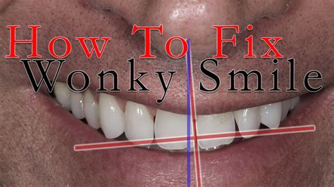 How To Fix A Wonky Smile Youtube