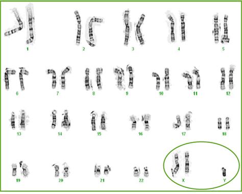 Dna X Chromosome 48 Xxyy Syndrome Is A Chromosomal Condition That Hot