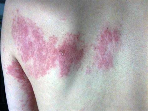Shingles Causes Symptoms Pictures Treatments And More