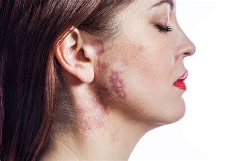 Port Wine Stain Birthmarks Everything You Need To Know