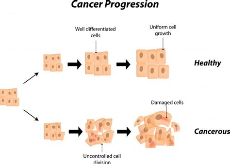 Stages Of Tumor Development And Characteristics Of Benign