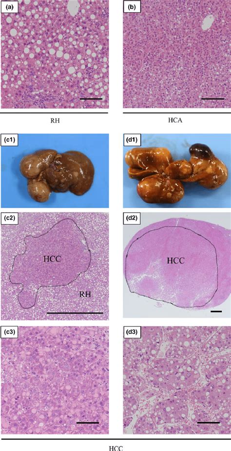 Representative Examples Of Changed Liver Histopathology Download