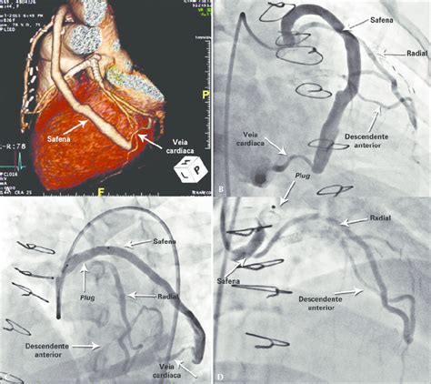 Caso 2 Angiotomografia Demonstrando Anastomose Safena Veia Cardíaca