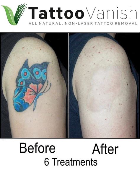 Before And After Tattoo Removal Get The Best Results The All Natural