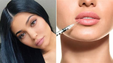 Lip Injections The Negative Side Effects You May Not Know Allure