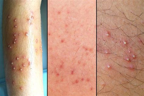 Folliculitis Uncovered Causes Symptoms Treatment And Prevention