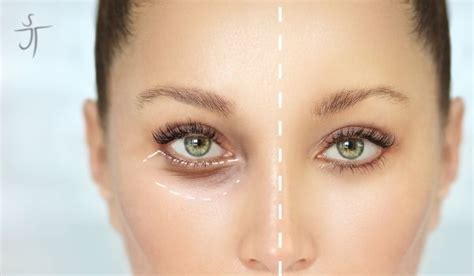 Reduce Swelling And Bruising After Eyelid Surgery Dr Scott Turner