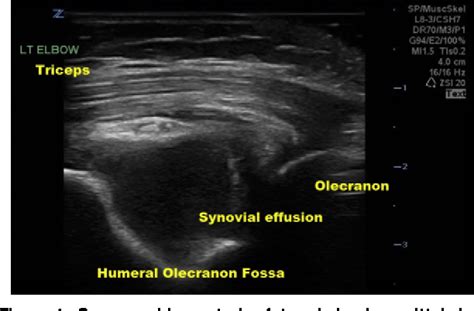 Figure 1 From Point Of Care Ultrasound Sonographic Posterior Fat Pad
