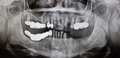 Cantilever Dental Bridge Design And Ada Dental Code Bauer Smiles