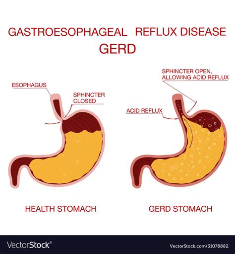 Heartburn And Gastroesophageal Reflux Disease Gerd