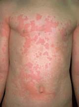 Cholinergic Urticaria Treatment Homeopathy Images