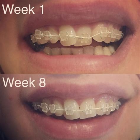 six month smiles provides a fast and effective method to straightening teeth