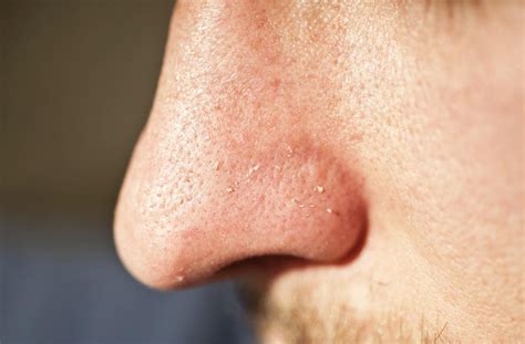 How To Get Rid Of A Zit On Your Nose Biotech